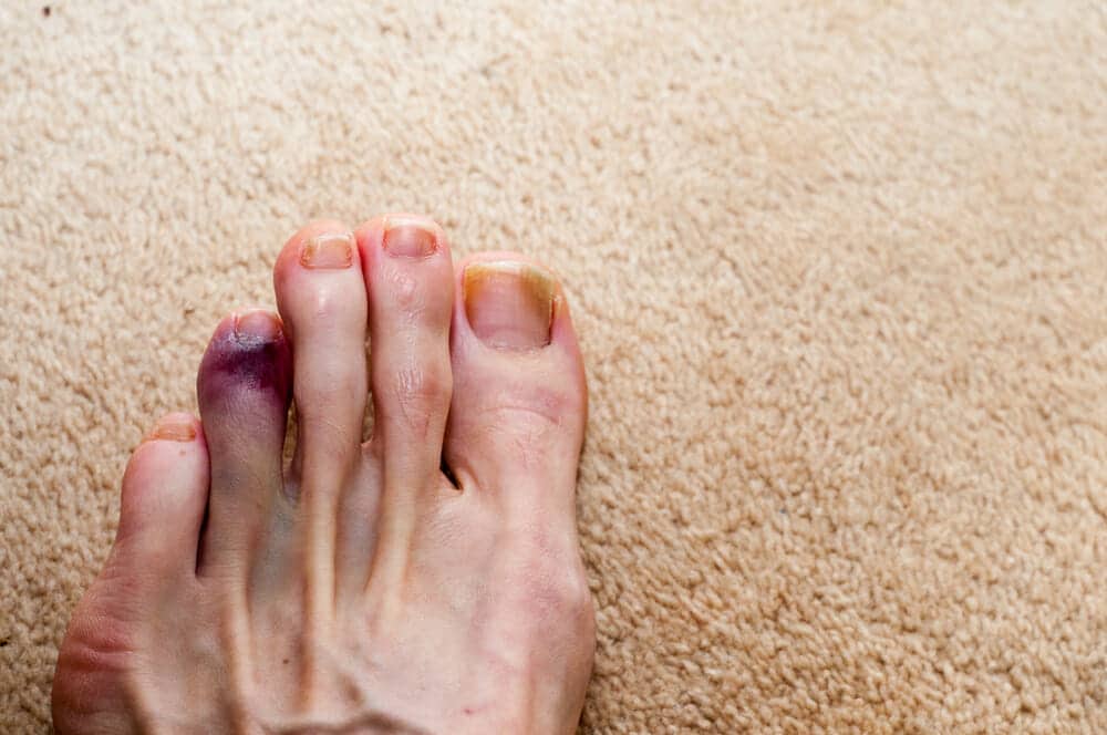 Health Tip Help A Broken Toe Heal HealthStatus