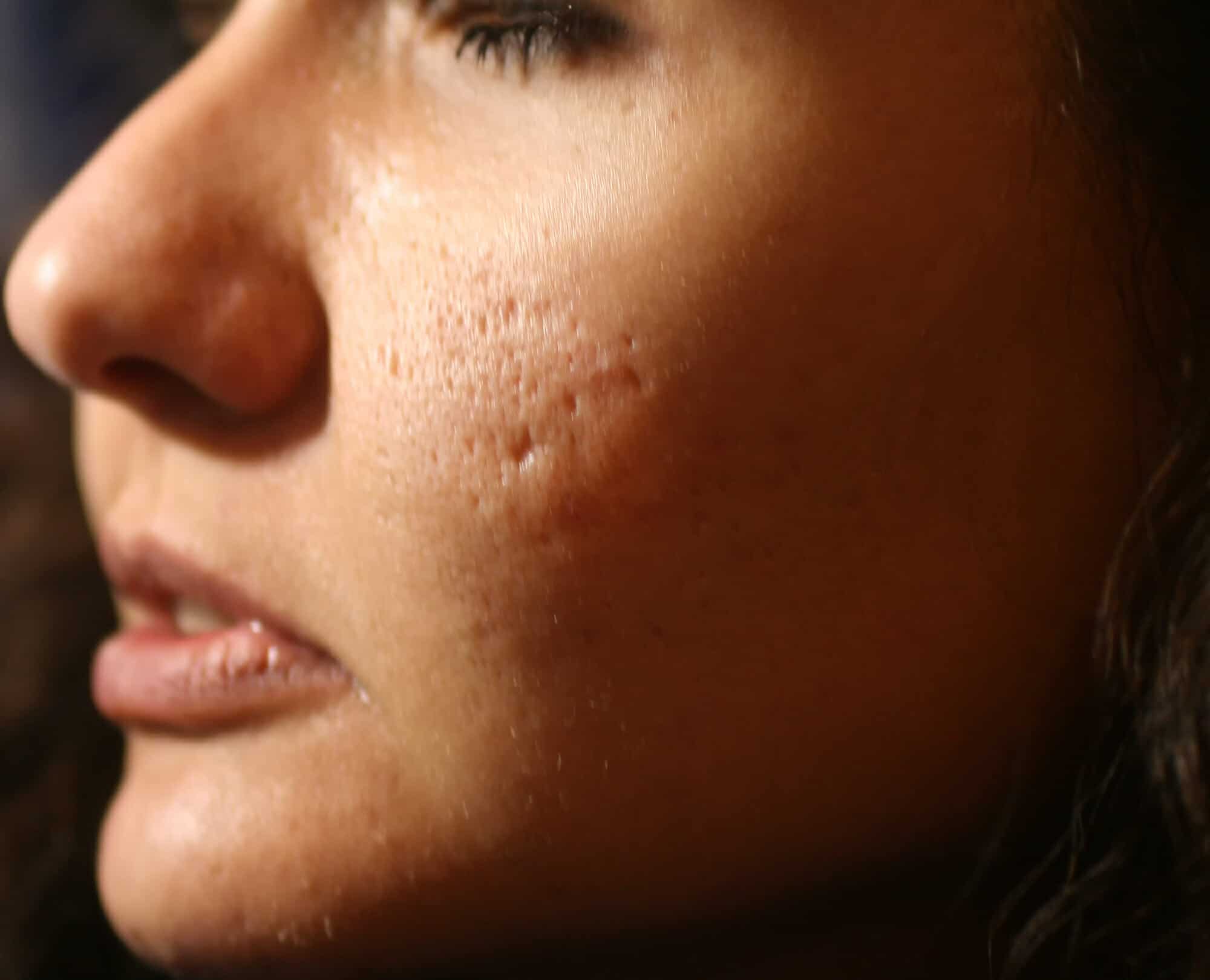 How To Get Rid Of Acne Scars HealthStatus