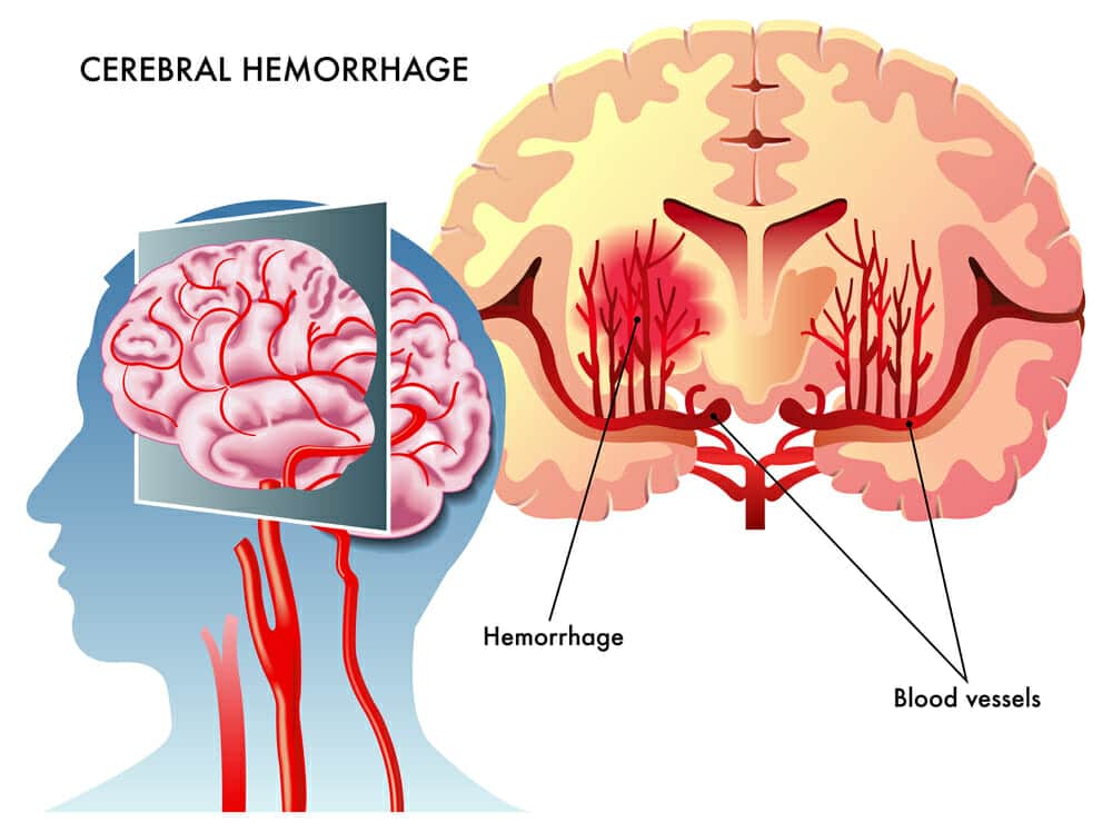 Brain Bleed Healthstatus