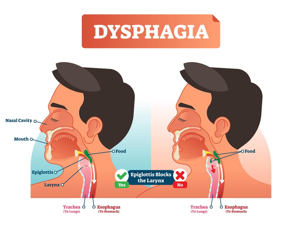 What Causes Sudden Difficulty In Swallowing