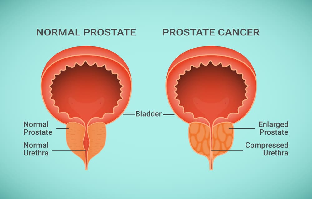 are-people-with-bph-at-risk-for-prostate-cancer-pon